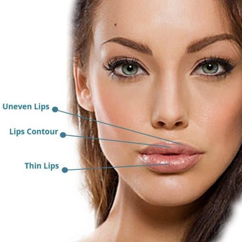 Lip Filler NY Beauti