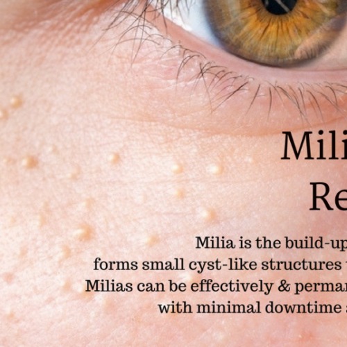 Milia Removal | NY Beauti