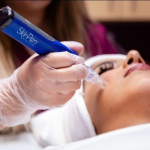 Microneedling
